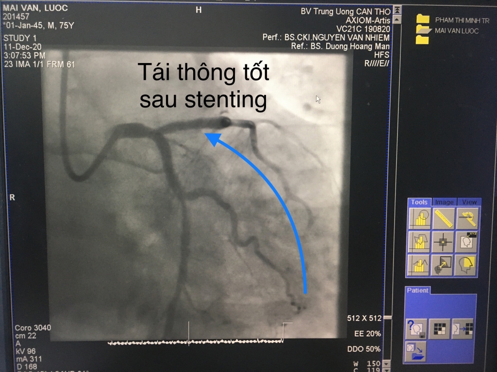 Hình ảnh động mạch vành sau can thiệp