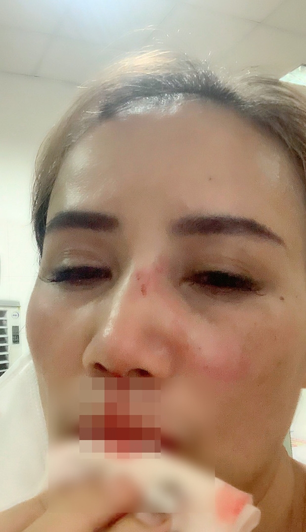 Gương mặt của diễn viên Hoàng Yến sau khi bị đánh