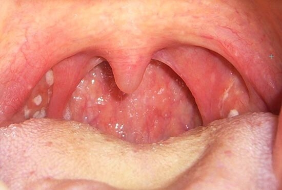 Viêm amidan là bệnh lý tai mũi họng phổ biến nhất
