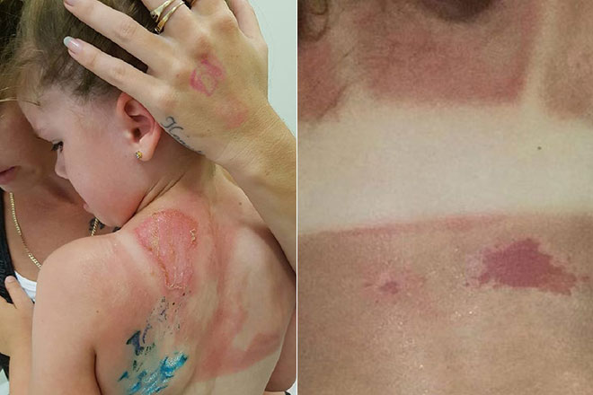 ​Da bé gái 5 tuổi bị lột từng mảng sau khi bôi kem chống nắng