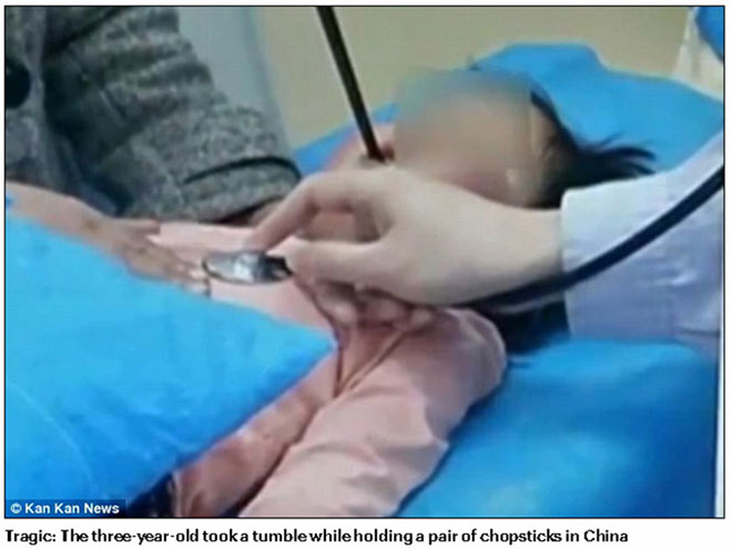 Hy hữu bé gái được cứu sống sau khi bị đũa đâm từ miệng xuyên thẳng lên não 4cm
