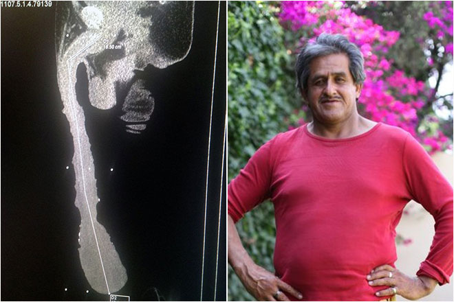 Người đàn ông khốn khổ khi “của quý” dài gần nửa mét