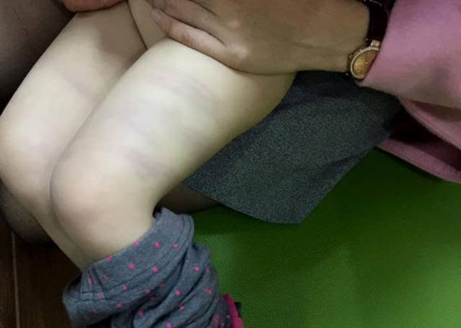 Cô giáo mầm non dùng đũa ăn cơm đánh trẻ thâm tím đùi ở Thanh Hóa gây phẫn nộ