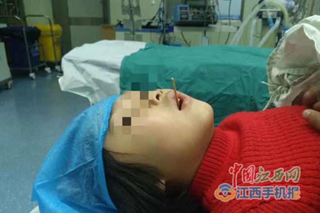 Cảnh báo: Bé gái ăn xúc xích bị que xiên đâm vào cổ họng