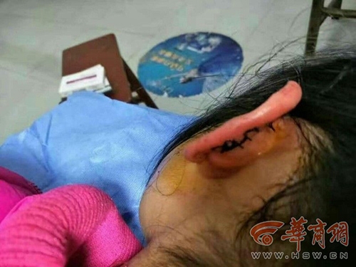 Trung Quốc: Bé gái lớp 2 bị cô giáo véo rách tai vì không làm xong bài tập