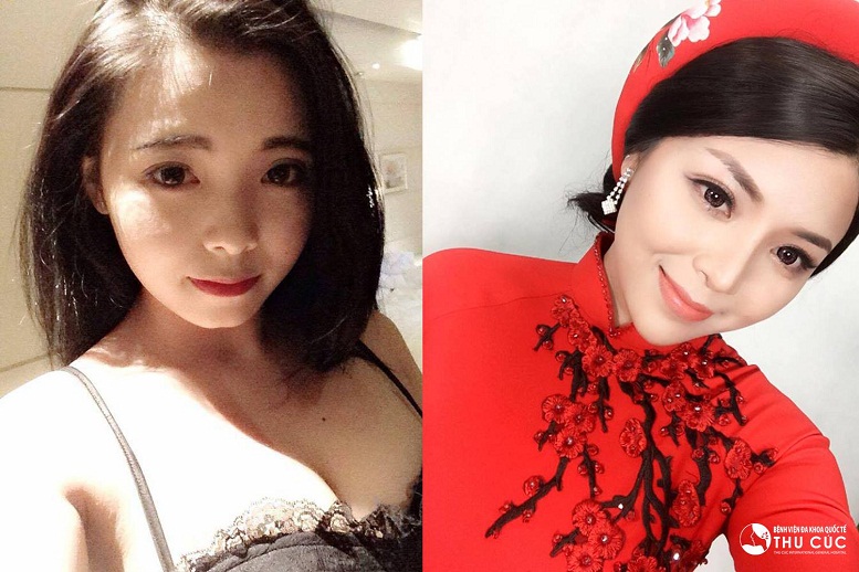 Nhìn lại xu hướng “lột xác” nhan sắc nhờ phẫu thuật thẩm mỹ