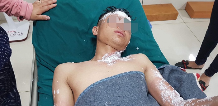Nhiều người nhập viện do pháo nổ