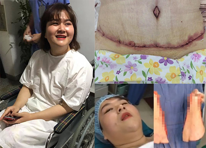 Thủy Tiên chia sẻ về ca phẫu thuật cắt mỡ bụng “ám ảnh như phim kinh dị”