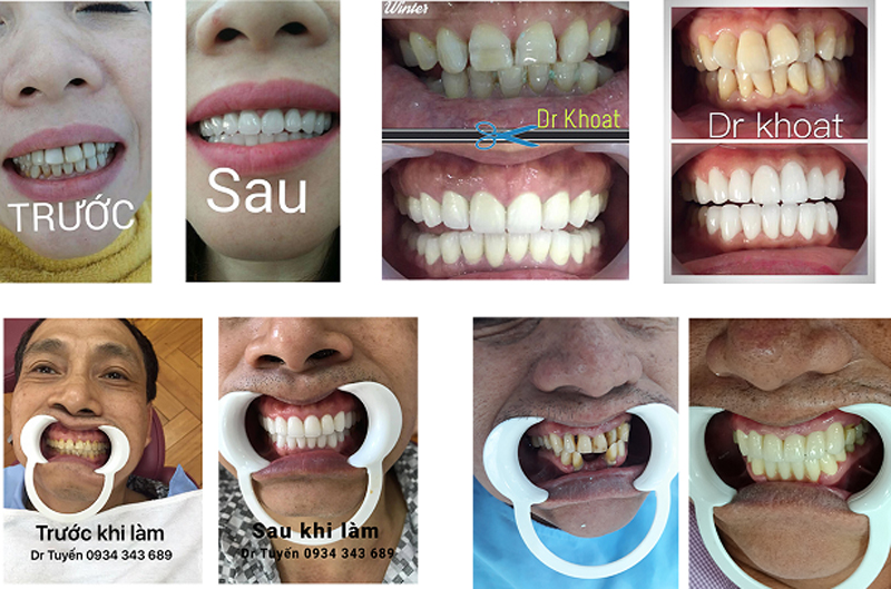 Nha khoa Việt Pháp Hà Nội - Trung tâm Nha khoa tiêu chuẩn Pháp tại Quảng Ninh