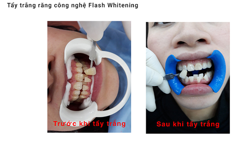 Nha khoa Việt Pháp Hà Nội - Trung tâm Nha khoa tiêu chuẩn Pháp tại Quảng Ninh
