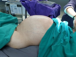 Phẫu thuật lấy khối u 25 kg từ bụng nam thanh niên