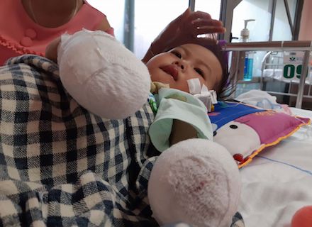 Biến chứng sau cơn sốt, một bé gái 3 tuổi phải cắt bỏ tứ chi