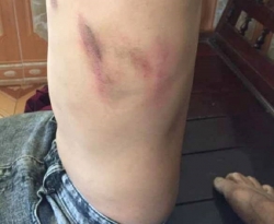 Thanh Hóa: Một học sinh bị phụ huynh xông vào trường đánh trọng thương
