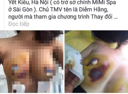 Làm rõ vụ bệnh nhân nâng ngực bị biến dạng tại Bệnh viện thẩm mỹ Kim Cương