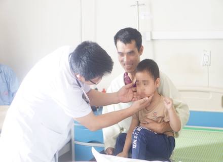 Trẻ bị mọc lông khắp mặt do dùng thuốc Corticoid