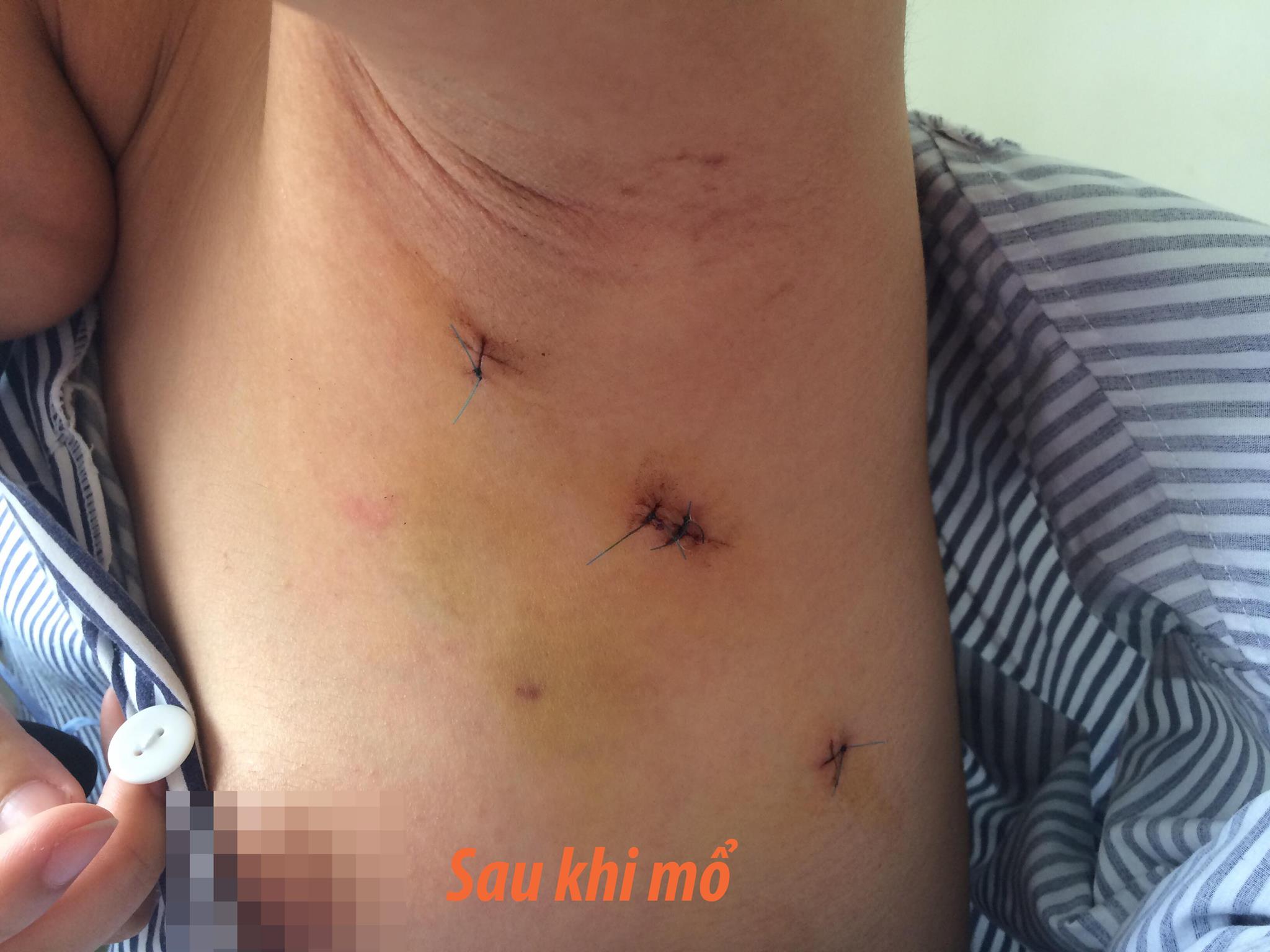 Lần đầu tiên thực hiện phương pháp mổ nội soi u xơ tuyến vú