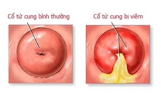 Viêm cổ tử cung có dấu hiệu khí hư màu vàng xanh rõ rệt.