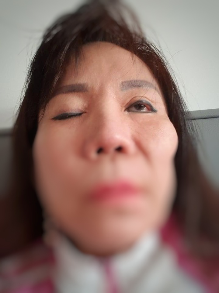 Sau phẫu thuật tại BVTM Kangnam, bà H.L bị lõm một bên má, một mắt không thể nhắm kín