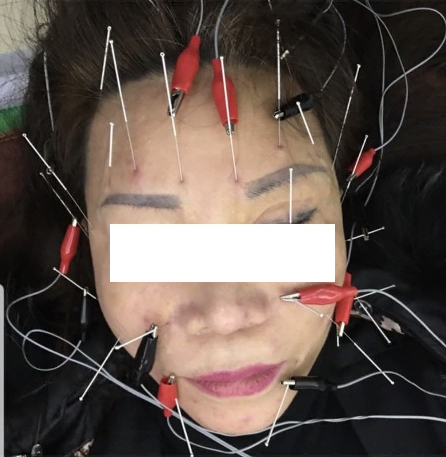 Sau khi phẫu thuật thẩm mỹ tại BVTM Kangnam, bà H.L phải châm cứu khắp khuôn mặt