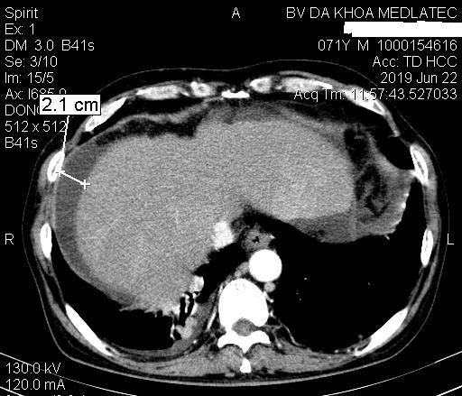Hình ảnh bất thường về gan của bệnh nhân khi chụp cắt lớp vi tính.