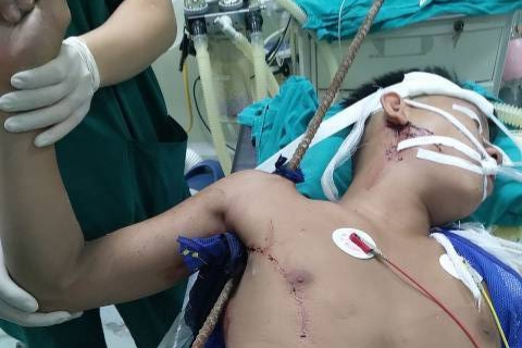 Cấp cứu nam thanh niên bị thanh sắt xuyên thấu từ nách qua vai