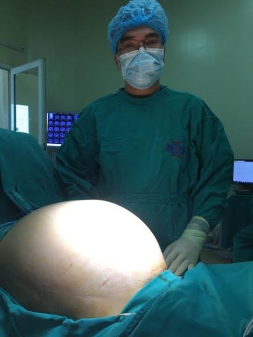 Phẫu thuật cắt bỏ khối u buồng trứng nặng 16kg cho cô gái 22 tuổi