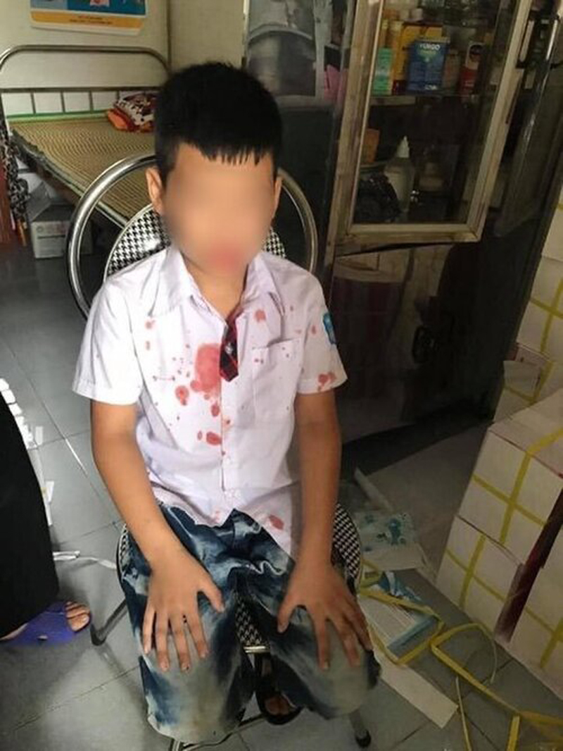 Bé K bị phụ huynh bạn học cùng lớp 1 trường Tiểu học Hữu Nghị (TP Hòa Bình, tỉnh Hòa Bình) hành hung gây thương tích