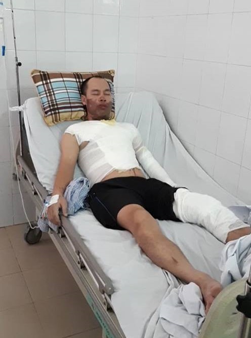Anh Bùi Văn Hậu đang được điều trị tại Viện bỏng Quốc gia.