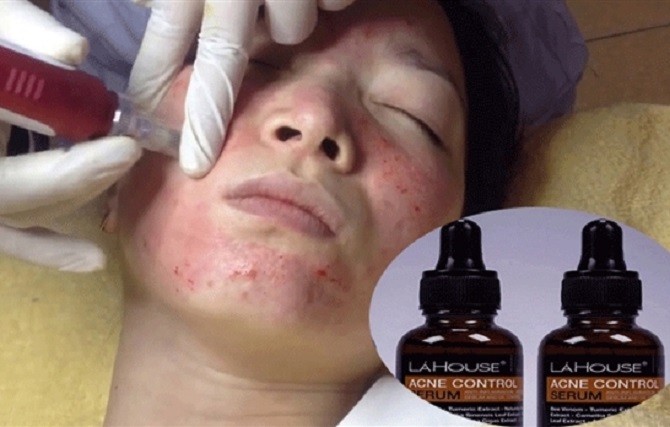 Đình chỉ lưu hành mỹ phẩm Acne control serum trị mụn