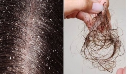 5 nguyên nhân gây rụng tóc và cách khắc phục