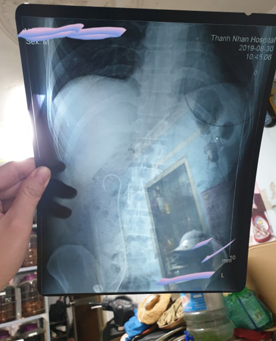 Hình ảnh chụp X - Quang cho thấy Sonde JJ nằm trong cơ thể bệnh nhân