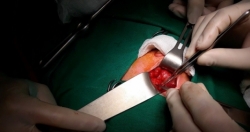 Phẫu thuật khối u kích thước u to gấp 5 lần quả thận bình thường.