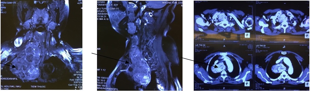 Hình ảnh khối u trên phim Cắt lớp vi tính và Cộng hưởng từ.