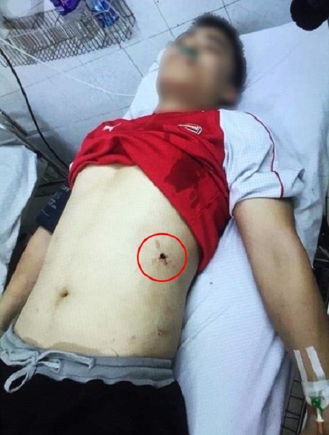 Một thanh niên bị bắn vào vùng bụng trong quá trình hỗn chiến
