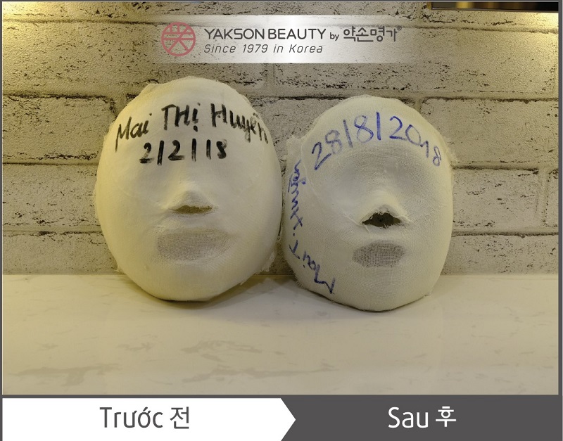 Mặt nạ thạch cao của chị Huyền buổi đầu tiên và buổi cuối cùng của liệu trình để theo dõi sự thay đổi của khuôn mặt.