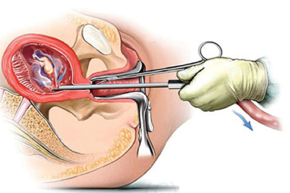 Việc nạo, phá thai cần được thực hiện dưới sự chỉ định của bác sĩ có chuyên môn.