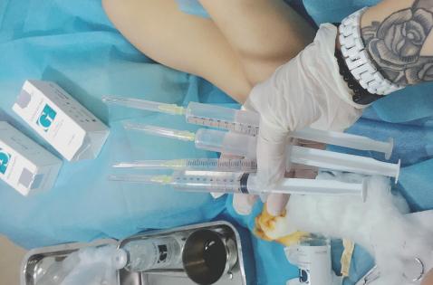 Sau bơm ngực, cô gái sốt cao, nửa ngực đầy ổ mủ