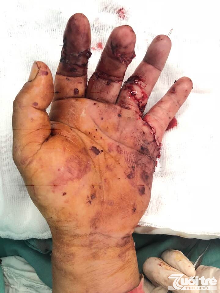 Bệnh viện T.Ư Huế: Ứng dụng thành công kỹ thuật vi phẫu nối ngón tay đứt lìa